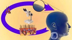 fut植發(fā)技術(shù)的優(yōu)點(diǎn)和缺點(diǎn)有哪些？