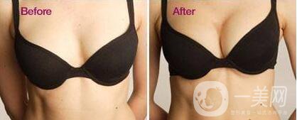 法國(guó)es假體隆胸,價(jià)格