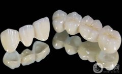 鈷鉻烤瓷牙好不好？可以保持多久？