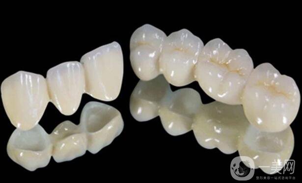 鈷鉻烤瓷牙好不好？可以保持多久？