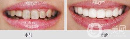 鈷鉻烤瓷牙好不好？可以保持多久？