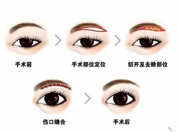 上海眉整形大概需要多少錢？