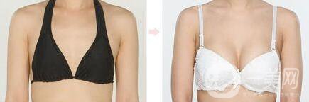 美國麥格假體隆胸怎么樣？麥格假體多少錢？