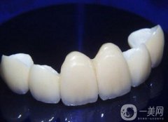 貴金屬烤瓷牙和全瓷牙信息介紹？