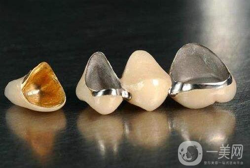 貴金屬烤瓷牙和全瓷牙信息介紹？