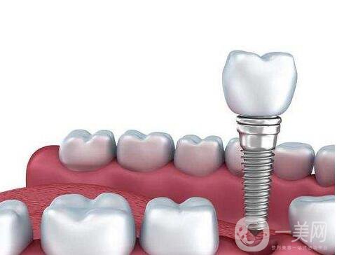 湖州,種植牙,價(jià)格