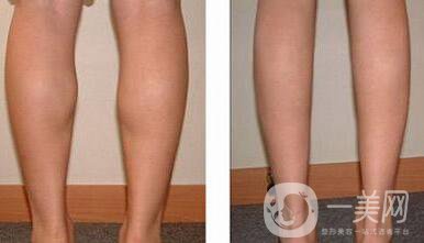 *瘦小腿反彈嗎？