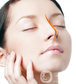 硅膠墊鼻梁多久生包膜？如何避免隆鼻后遺癥？