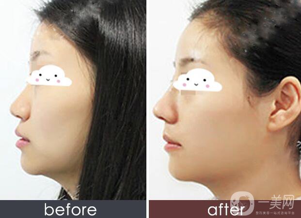 硅膠墊鼻梁多久生包膜？如何避免隆鼻后遺癥？