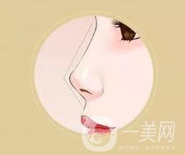 朝天鼻矯正*果是*的嗎 怎么才能擁有明星翹鼻