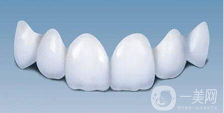 貴金屬烤瓷牙,種類(lèi),優(yōu)點(diǎn)