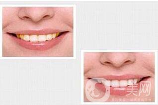 貴金屬烤瓷牙,種類(lèi),優(yōu)點(diǎn)