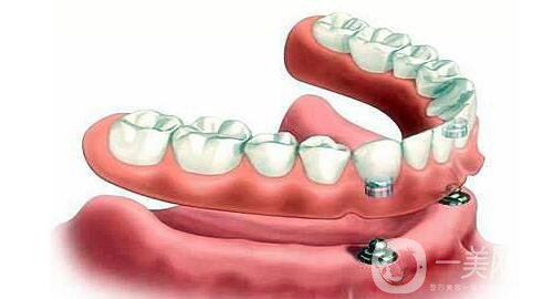 昆山種植牙價(jià)格一般是多少錢(qián)