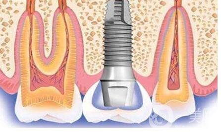 種植牙,術(shù)后注意事項