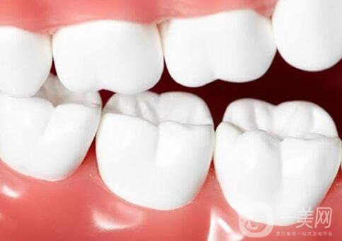 貴金屬烤瓷牙,多少錢