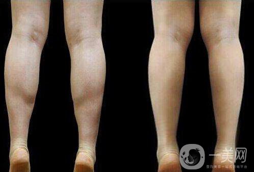 神經(jīng)瘦小腿