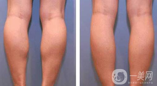 南京注射**多少錢