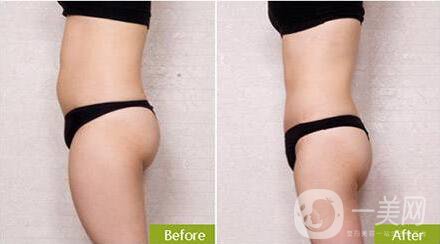 環(huán)形吸脂價(jià)格是多少?360度環(huán)形吸脂多久恢復(fù)?