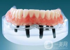 上海九院種植牙價(jià)格要多少錢(qián)？