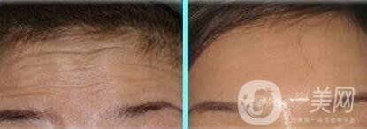 激光去抬頭紋怎么樣、*果*嗎