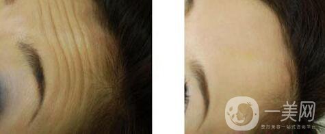 激光去抬頭紋怎么樣、*果*嗎