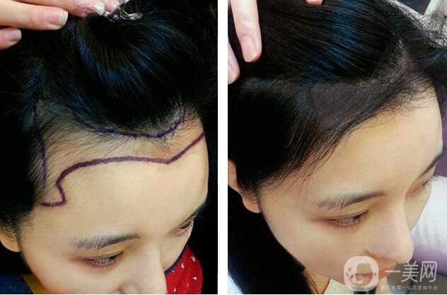 鄭州,植發(fā)醫(yī)院