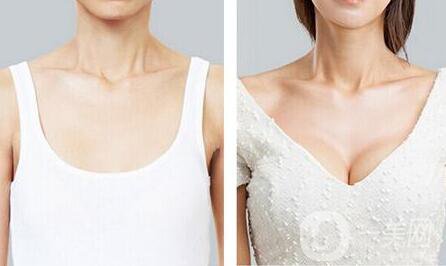 假體隆胸*果到底能維持多久