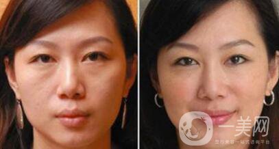 塑美極*果怎么樣？塑美極要做多少次？