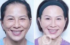 塑美極果怎么樣？塑美極要做多少次？