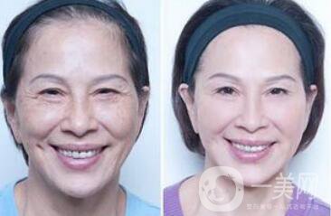 塑美極*果怎么樣？塑美極要做多少次？