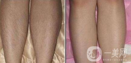 怎么去腿毛？*脫腿毛的方式是什么？