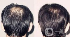 蛋白纖維植發(fā)好不好？植發(fā)解決頭發(fā)稀疏的問題