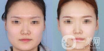 怎樣變瓜子臉？磨骨整形還是*？