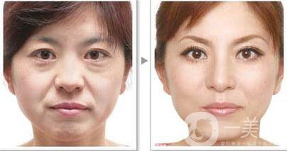 *除皺*嗎？可以維持多久的時(shí)間？