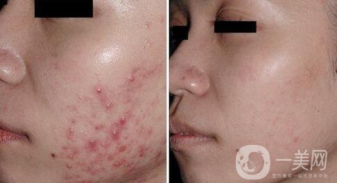 果酸換膚*嗎？果酸換膚要做幾個(gè)療程？