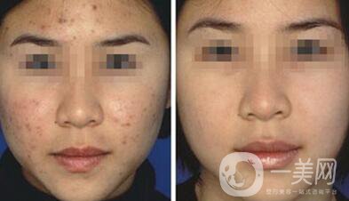 果酸換膚*嗎？果酸換膚要做幾個(gè)療程？