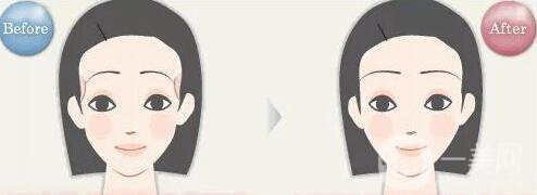 豐太陽(yáng)穴,價(jià)格