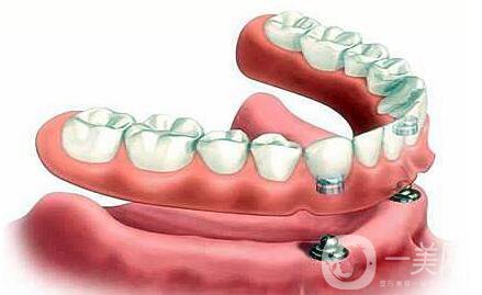 昆山,種植牙,多少錢(qián)
