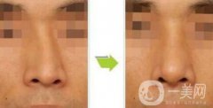 歪鼻矯正術(shù)難度大嗎？手術(shù)注意事項(xiàng)有哪些？