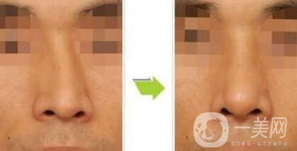 歪鼻矯正術(shù)難度大嗎？手術(shù)注意事項(xiàng)有哪些？