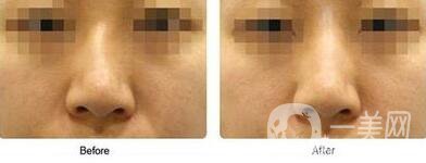 歪鼻矯正術(shù)難度大嗎？手術(shù)注意事項(xiàng)有哪些？