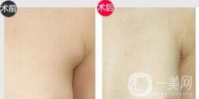 副乳切除什么時(shí)候進(jìn)行比較好