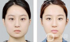 怎樣變瓜子臉？可以打*嗎？