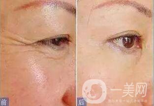 *去魚(yú)尾紋,*果