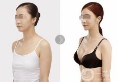 假體隆胸恢復(fù)期要多久 假體隆胸輕松擁有網(wǎng)紅傲人身材