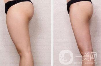 大腿吸脂后多久消腫 吸脂瘦腿輕松鉛筆腿get