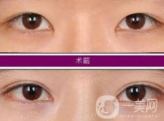 開眼角增生了能恢復嗎?開眼角會留疤嗎