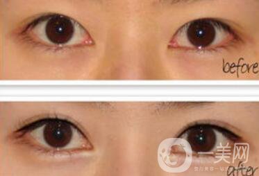 開眼角增生了能恢復嗎?開眼角會留疤嗎