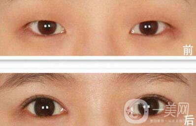 開眼角如何防止增生 開眼角輕松放大雙眼