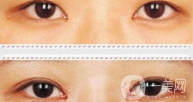 開眼角術后要眼角增生自己會消失嗎